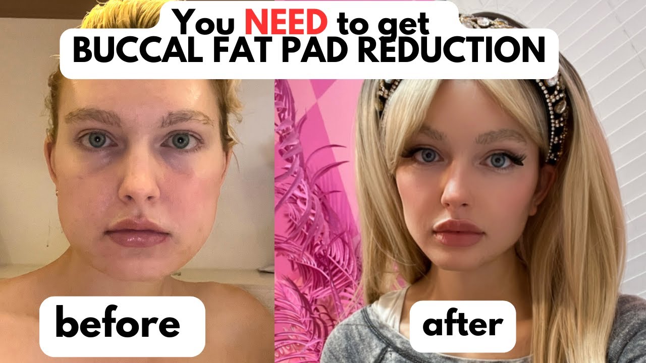 You NEED buccal fat pad reduction!!! MY EXPERIENCE + ONE YEAR AFTER RESULTS