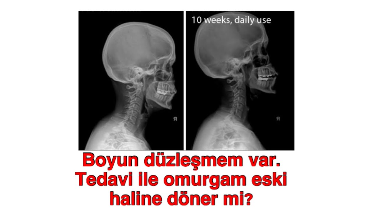 BOYUN DÜZLEŞMEM VAR, TEDAVİ İLE OMURGAM ESKİ HALİNE DÖNER Mİ?
