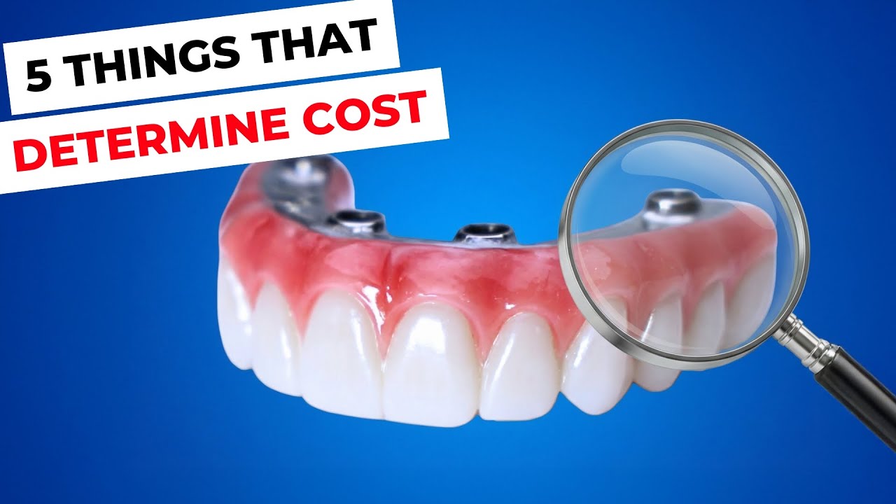 Full Mouth Dental Implants. What Impacts Cost?