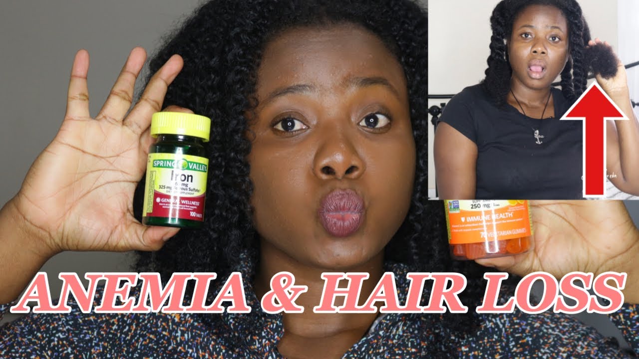 ANEMIA & HAIR LOSS: MY ANEMIA  STORY AND TREATMENT. Anemia, symptoms, treatments etc