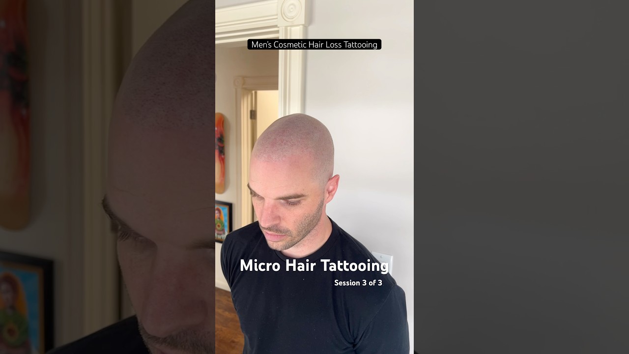 Men’s Micro Hair Tattooing - Scalp Micropigmentation 