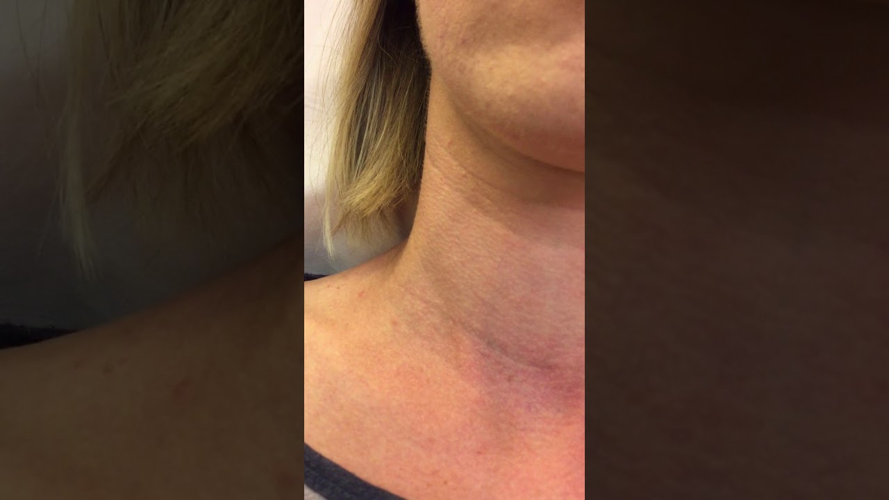 Jugular Vein Distention | MedBridge