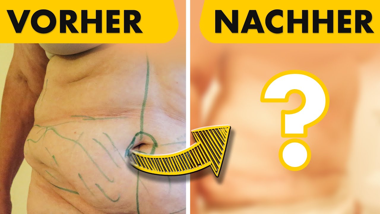 Von 125kg auf 77kg! Sie zeigt sich vor und nach Bauchdeckenstraffung! | Dr. Jungwirth