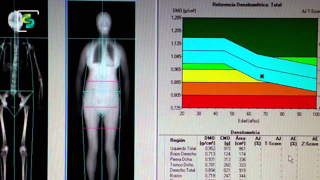 Densiometría ósea - Salud + Deportes - PGM 07 - B2