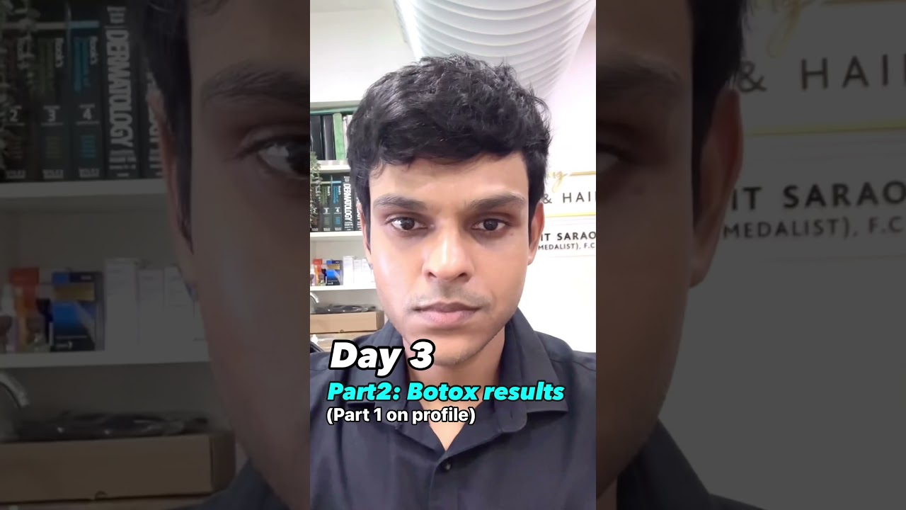 Results Of Botox Treatment | Transformation  #everythingskinhair #drpunitsaraogi