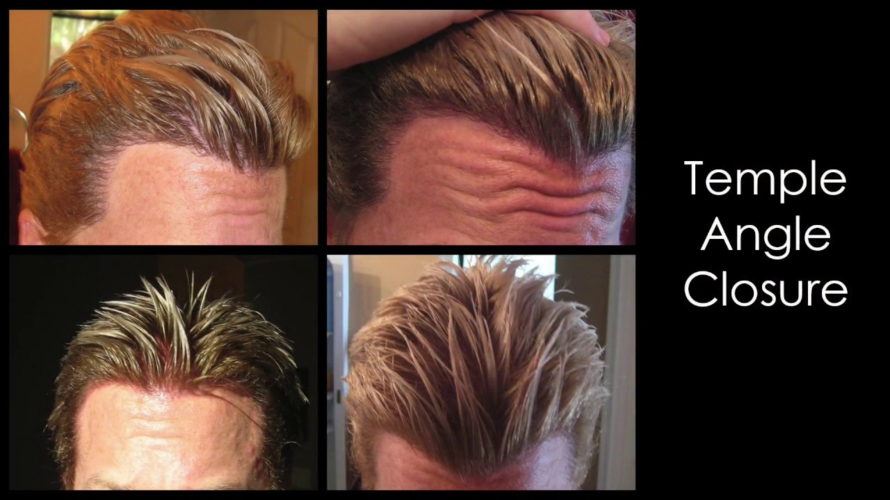 Los Angeles Hair Transplant Doctor:  &ndash; Most published results