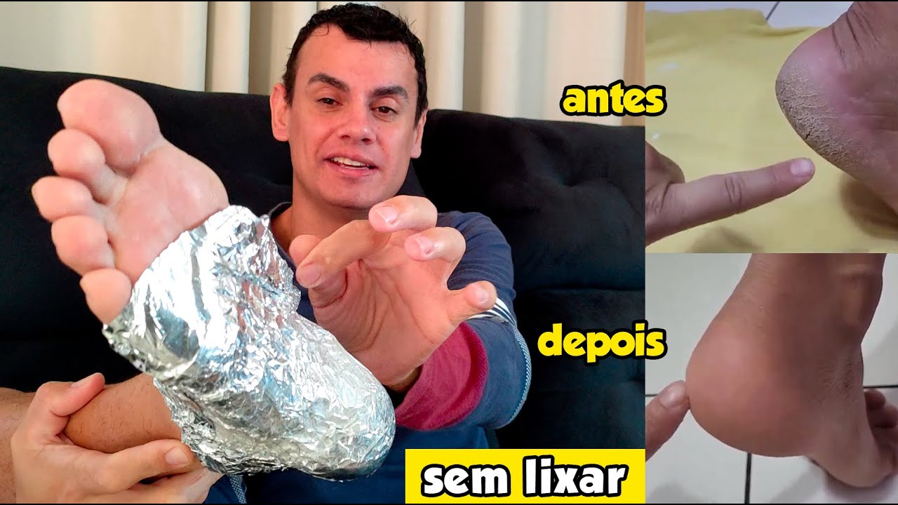 ✅ SOLUÇÃO PARA PÉS RESSECADOS E CALCANHAR RACHADO - Fubá online