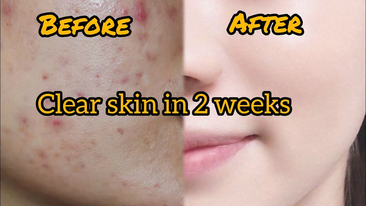 Get clear skin in just 2 weeks, no acne , no acne scars , no whiteheads , no blackheads...
