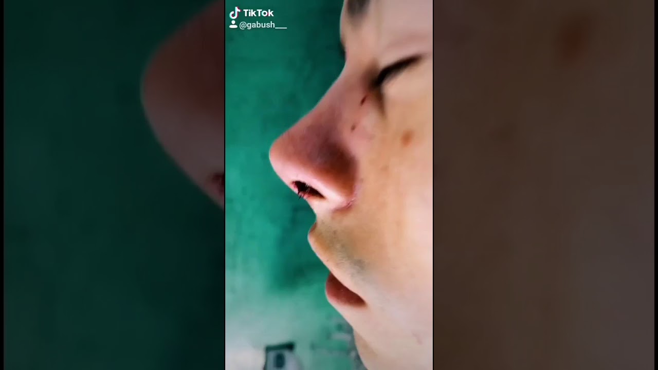 Cómo cambia la NARIZ despues de una RINOPLASTIA  | Antes y despues