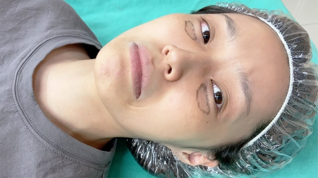 做除眼袋手術🥸術後保養、半年後恢復狀況（在資訊欄）