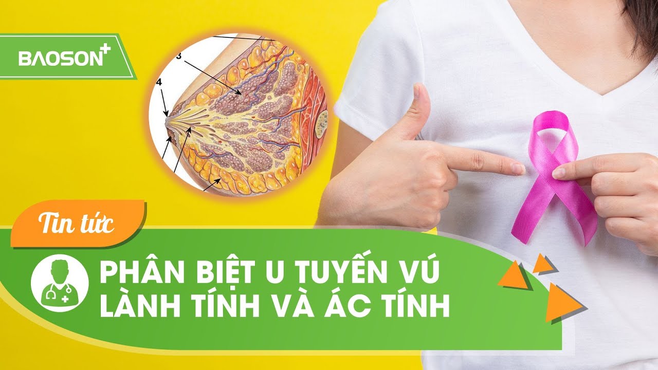 4 điểm phân biệt u tuyến vú lành tính & ác tính | Bệnh Viện Đa Khoa Bảo Sơn