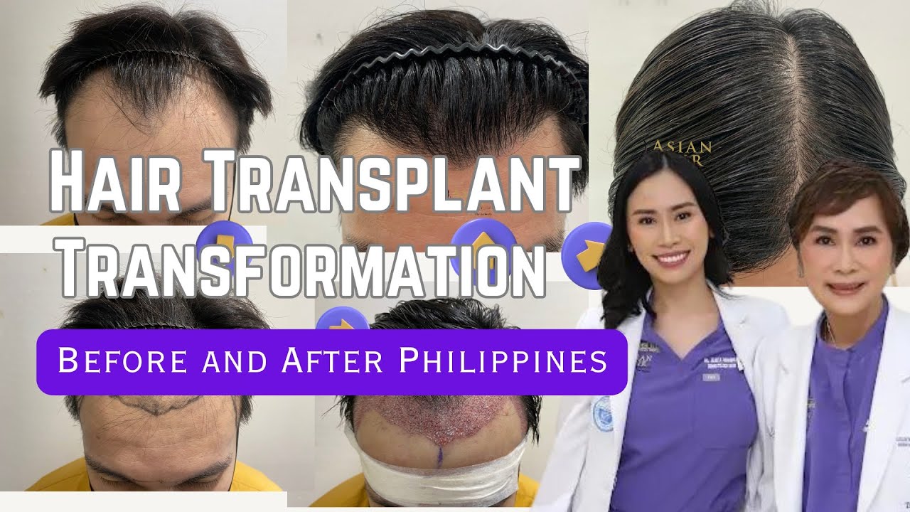 Hair Transplant Transformation Before and After Philippines | ABHRS Certified Surgeon | FUE & STRIP