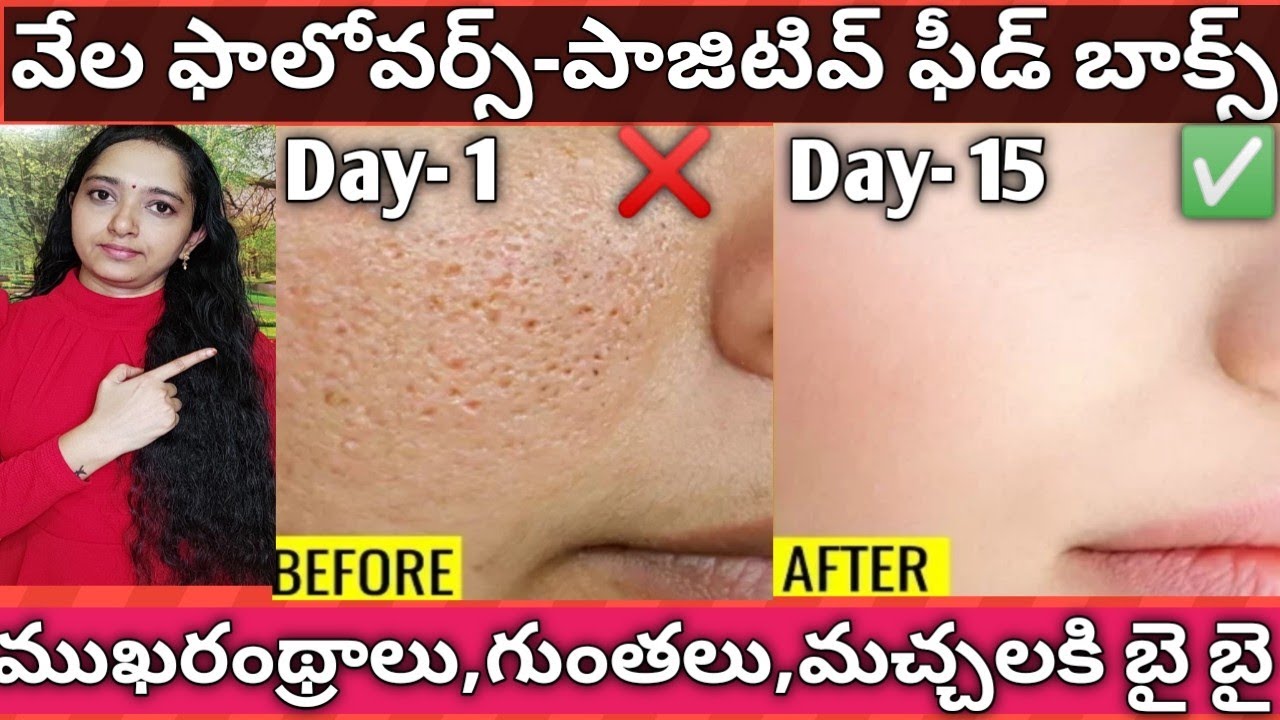 How To Remove Open pores Naturally in Telugu/How To Reduce Open Pores On face in Telugu/#OpenPores