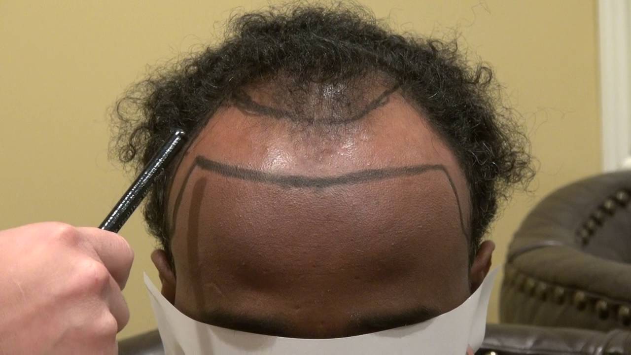 Los Gatos Hair Transplant For Balding Men  Dr. Diep www.mhtaclinic.com
