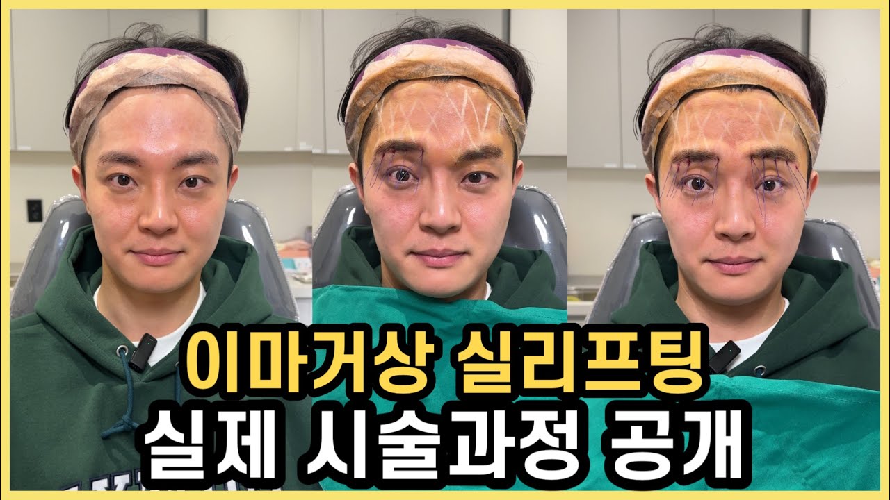 이마거상 실리프팅 실제 시술과정 공개합니다!