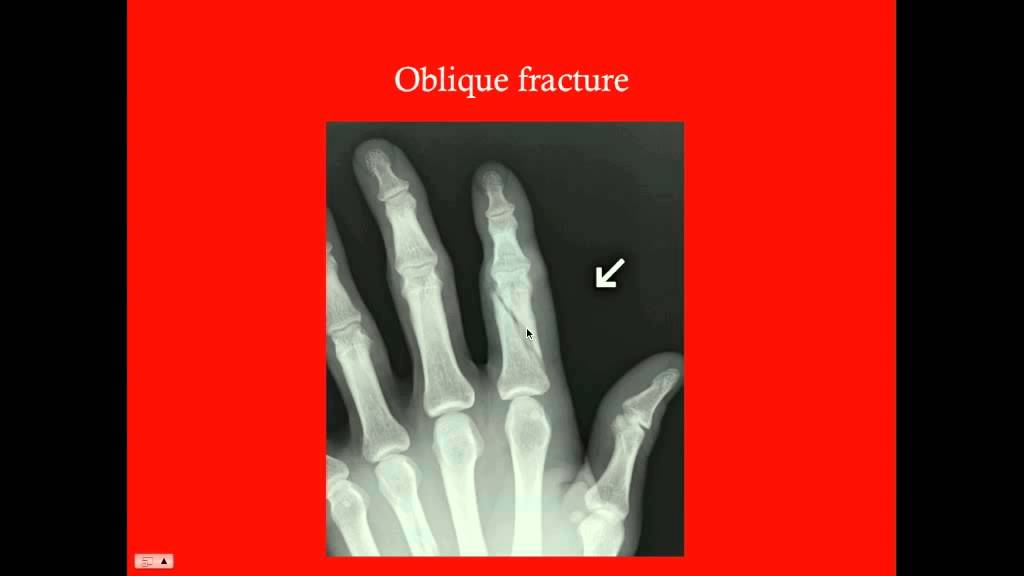 General Fractures - CRASH! Medical Review Series
