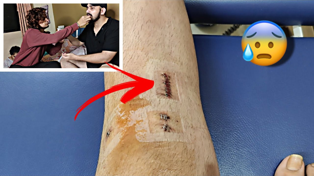 ITNA DARD😭 (stitches removal) | 50K CELEBRATION😍 | RUSHI DAVE.