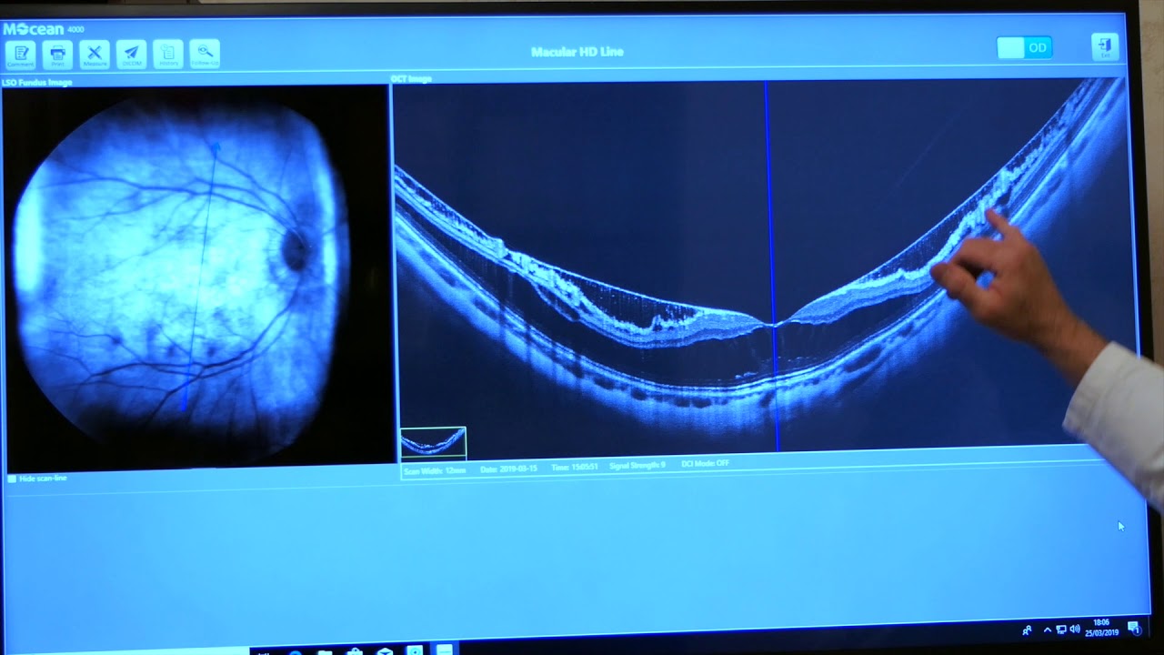 OCT e membrane epiretiniche - Vitrectomia