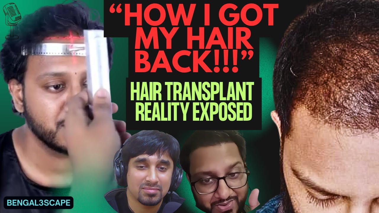 Hair Transplant in Bangladesh: Real Results & Cost | Fitness Guy Shares Being Bullied For Obesity!