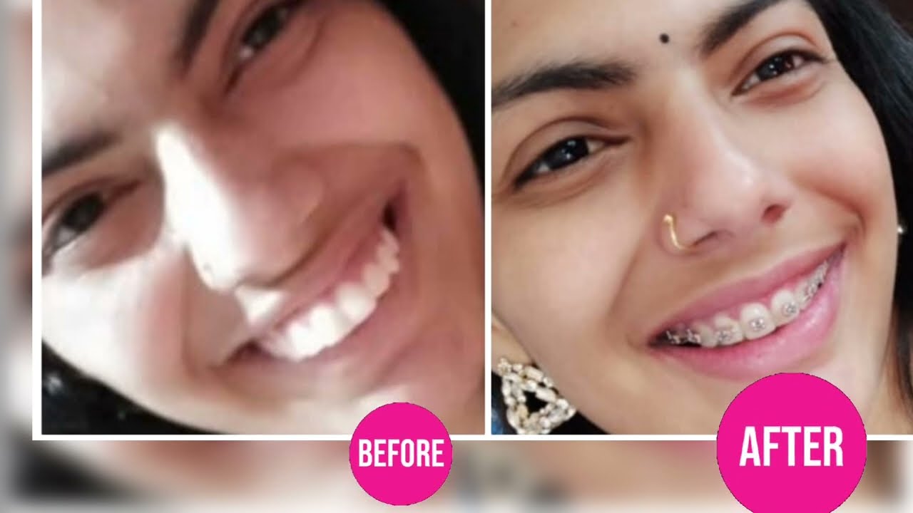 Forwardly placed teeth# mini implant# extraction # viral# braces# Dr Babita Verma MDS
