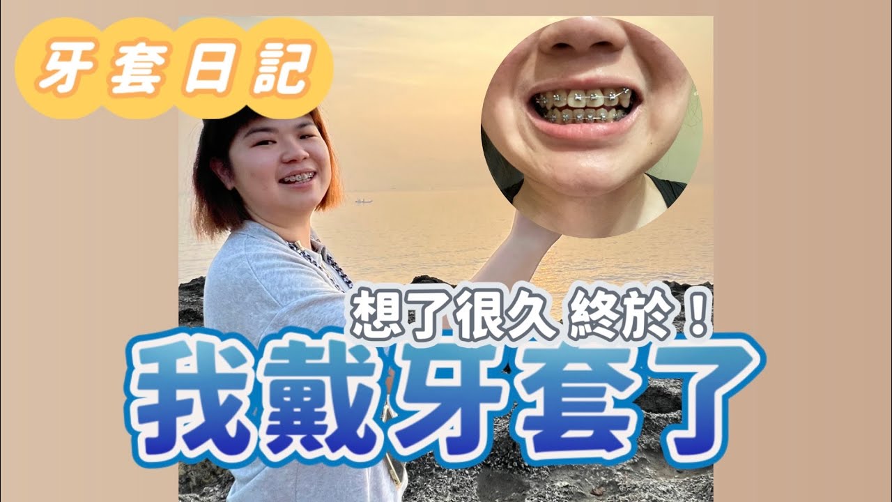 ［牙套日記Braces Diary］我戴牙套了！好新奇的感覺喔