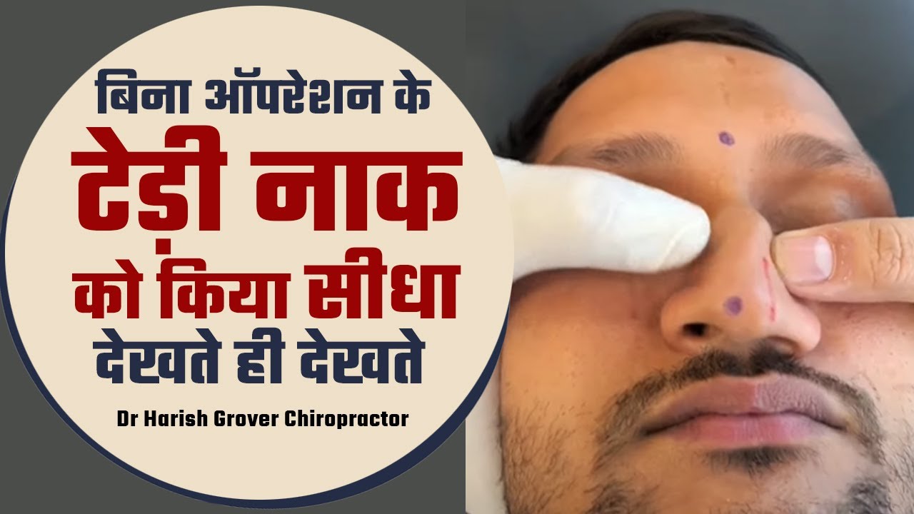 टेड़ी नाक को किया सीधा देखते ही देखते रिज़ल्ट बिना ऑपरेशन के Dr  Harish Grover Chiropractor