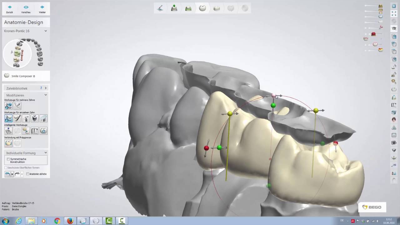 Design einer dreigliedrigen Brücke mit dem 3Shape Dental Designer 16.1.0 (für Einsteiger)