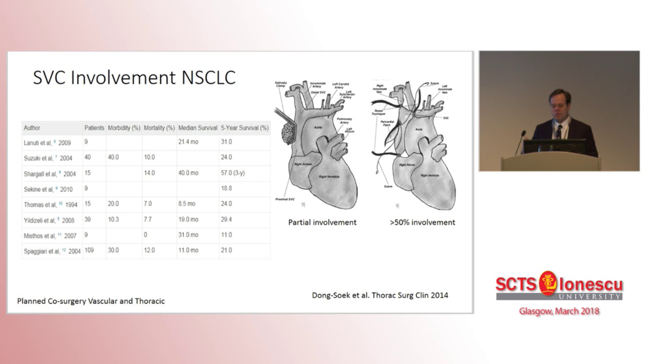 SCTS 2018 - SSurgery with the Vascular Surgeon - D Harpole