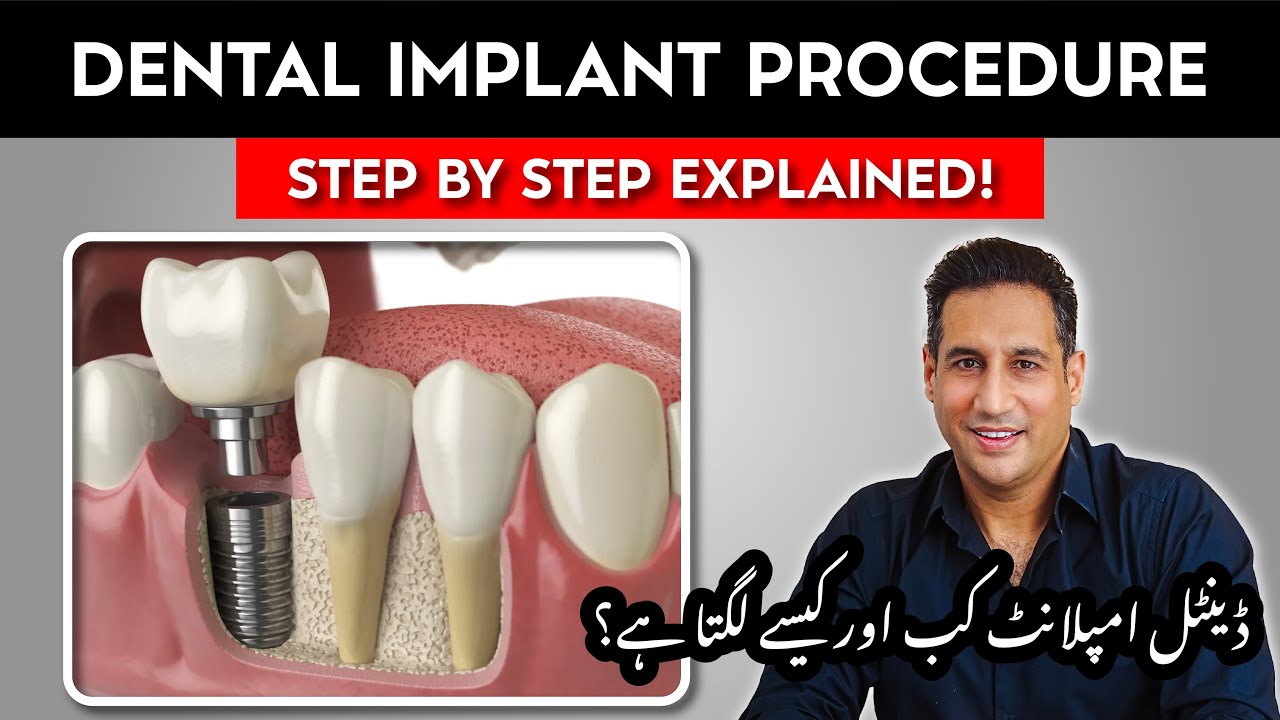 Dental Implants Procedure Step By Step Explained | Best Dentist in Pakistan | Dental Clinic Lahore