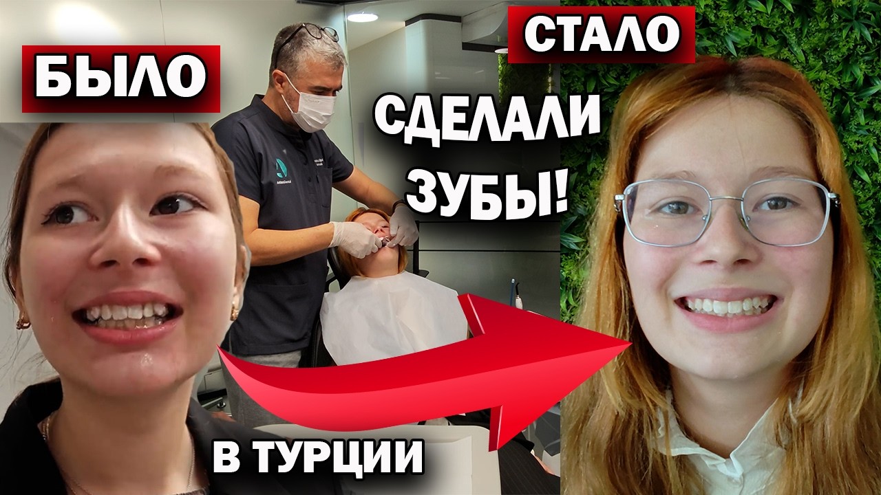 ❗ГОЛЛИВУДСКАЯ УЛЫБКА! Делаем зубы в Турции: ДО И ПОСЛЕ!  Медицинский туризм Antlara Dental