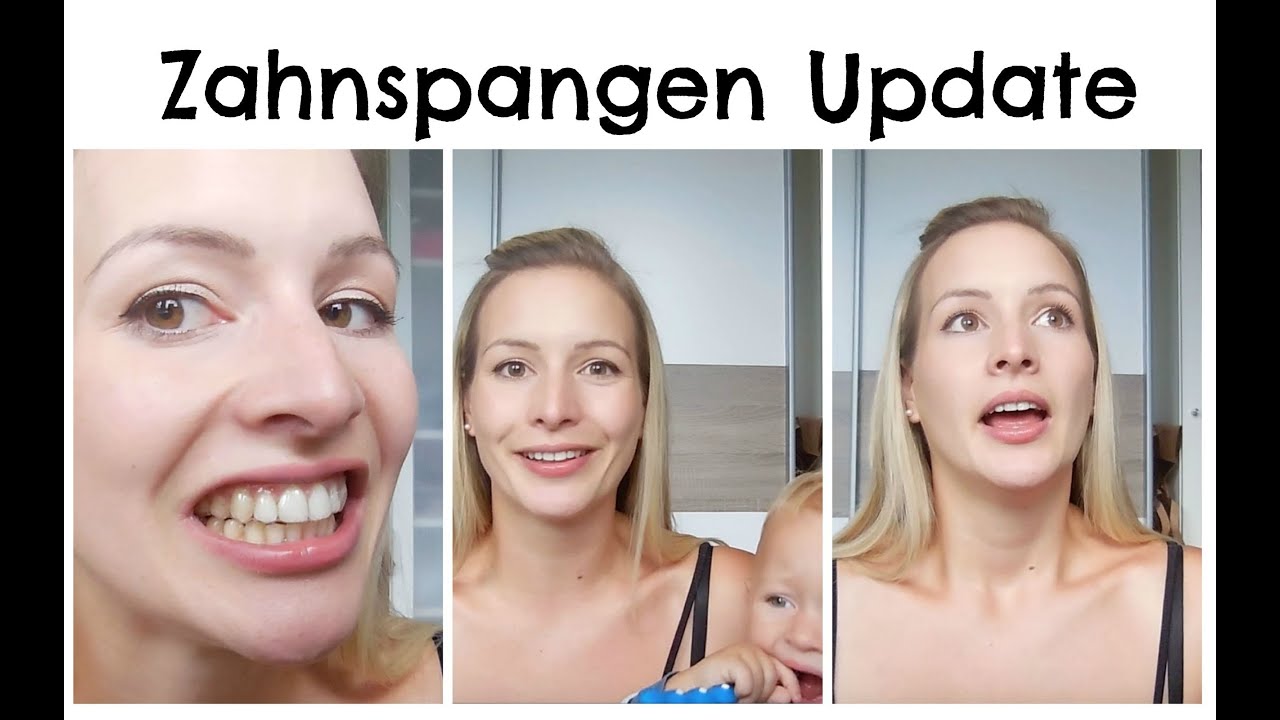 Zahnspangen - Update I Lose Spange I Kosten I AnnaBirdie