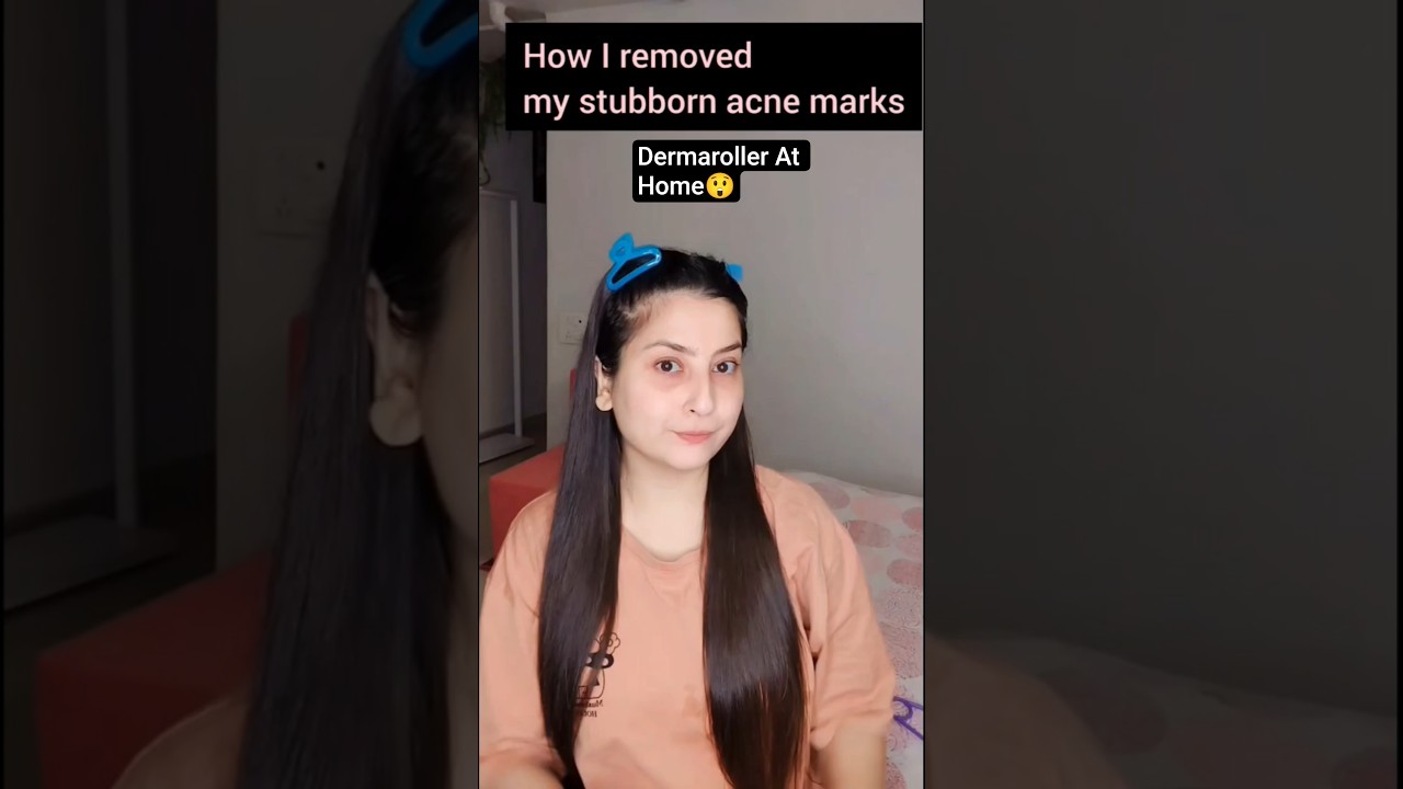 How I Removed My Acne Mark By Dermaroller At Home 