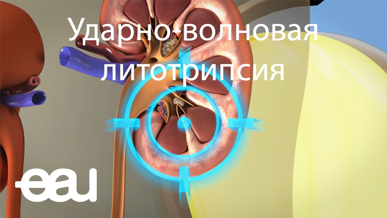 Ударно-волновая литотрипсия (EAU - SWL RU)