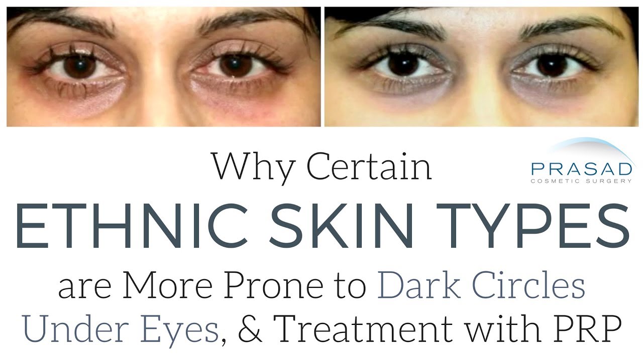 How Certain Ethnic Skin Types are More Prone to Under Eye Dark Circles, and How to Treat Them