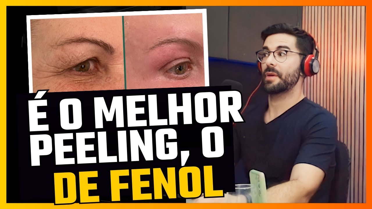 PEELING DE FENOL em pauta no WISECAST - com Dr. Thiago Moura, Dr. Diogo Branco e Dra Camila Branco
