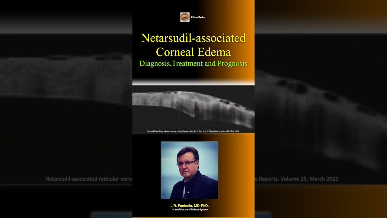 Edema Corneal asociado a Netarsudil Colirio: Diagn&oacute;stico, Tratamiento y Pron&oacute;stico. #cornealedema