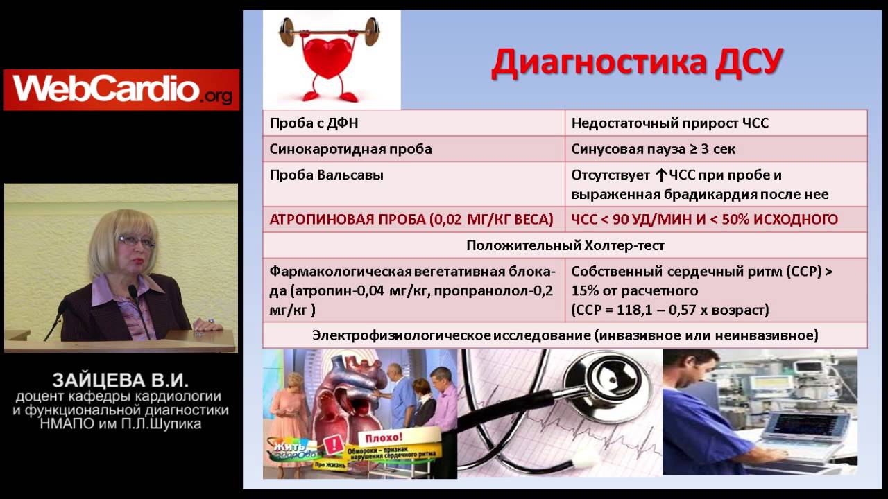 Синдром слабости синусового узла