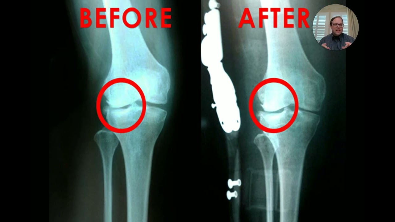 🦵 Advanced Arthritis Relief Protocol&trade; &ndash; 🔑 Turn-Key Knee OA Solution for Progressive Practices
