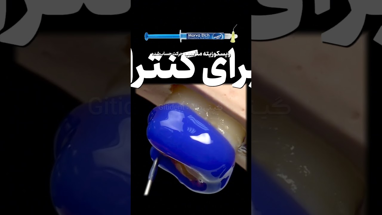 اسید اچ 37% مروابن، ترمیم ماندگار #دندانپزشکی #ترمیم #اسید