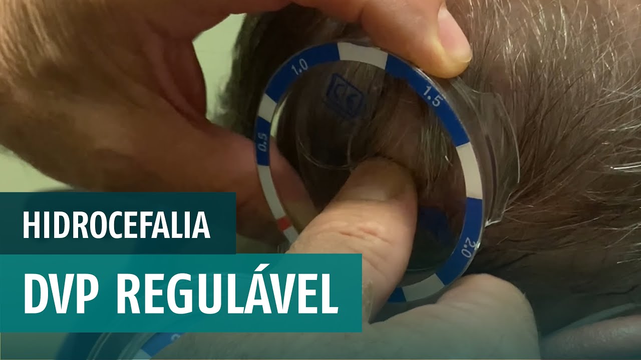 Programação de válvula de hidrocefalia - DVP Regulável