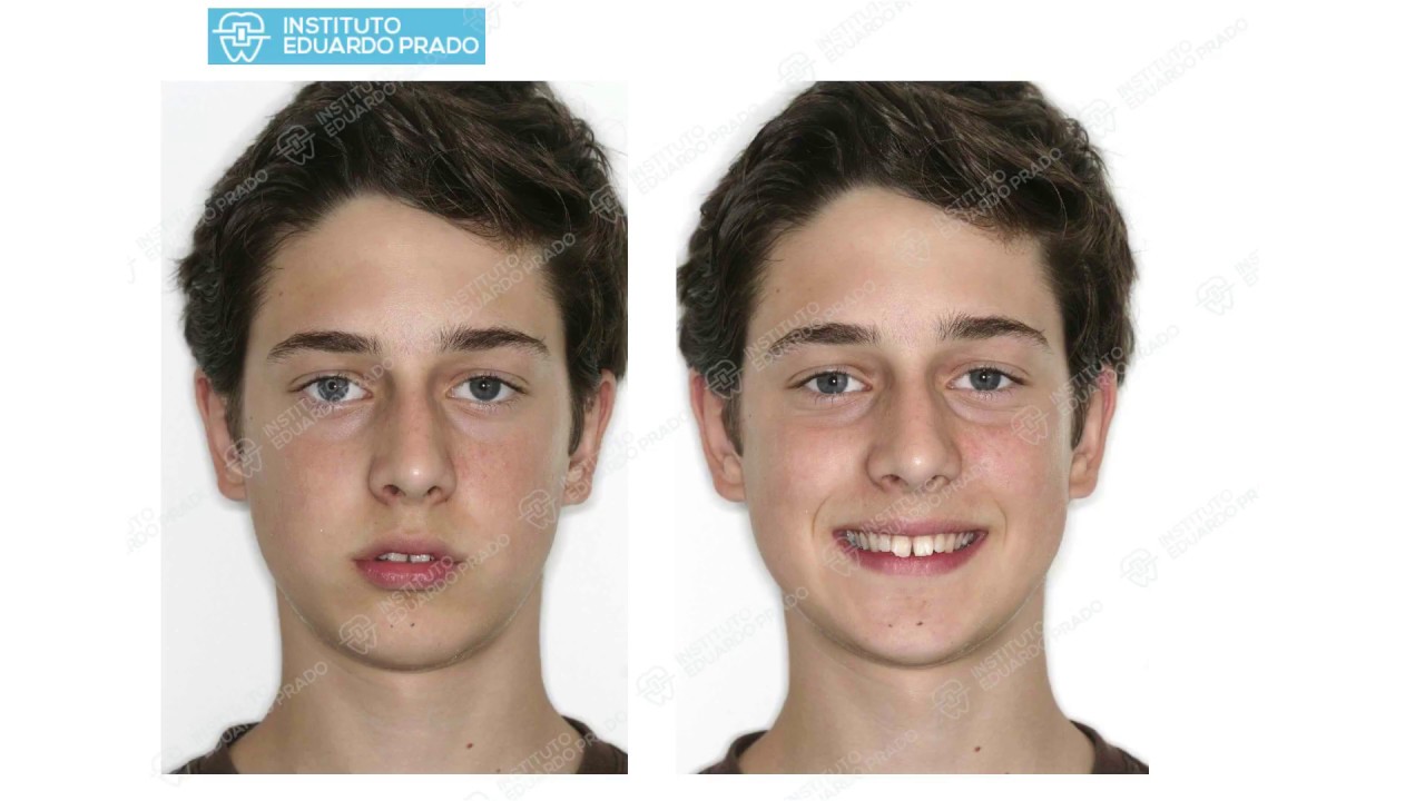 Classe II Completa Bilateral - Prof. Eduardo Prado - Sobresp