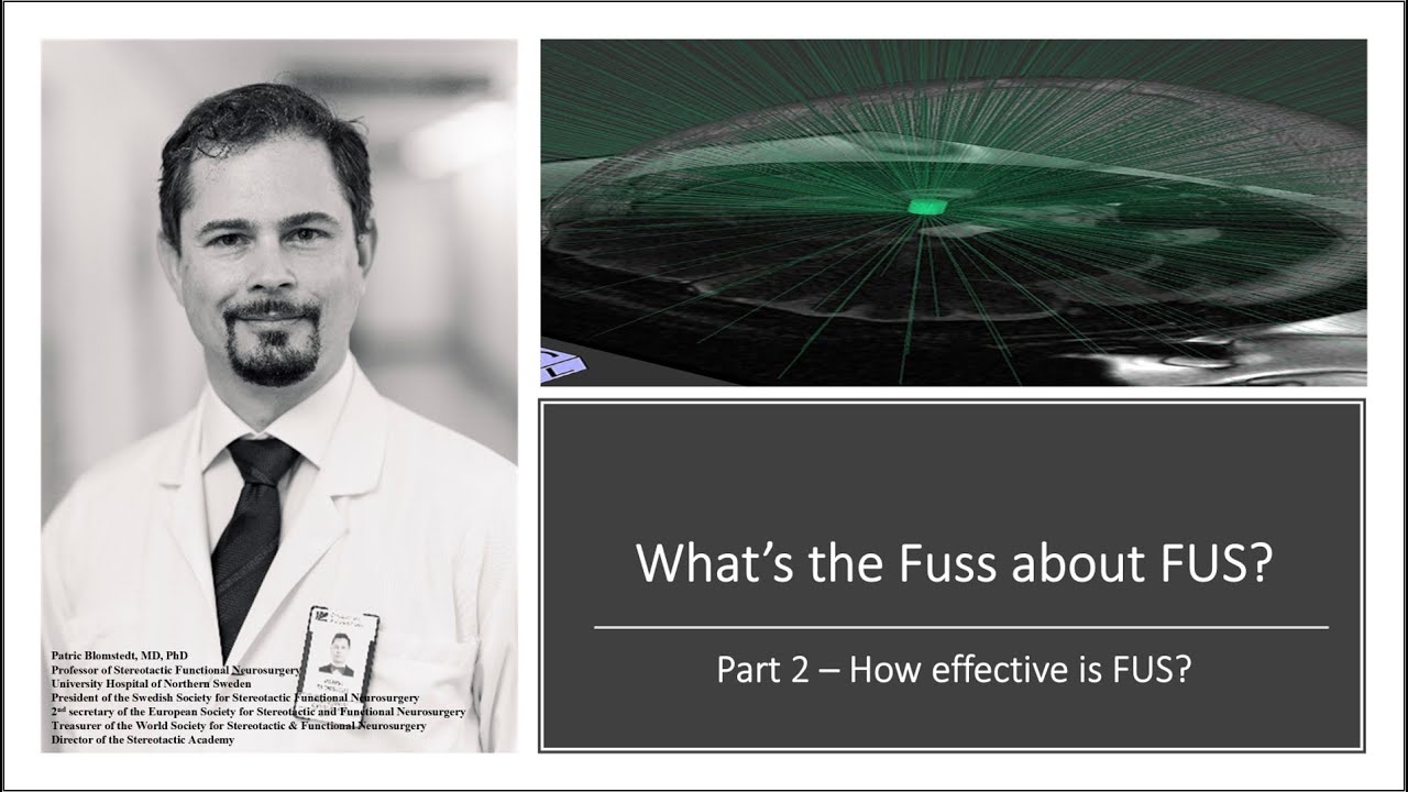 What's the fuss about FUS - Part 2: How effective is FUS?