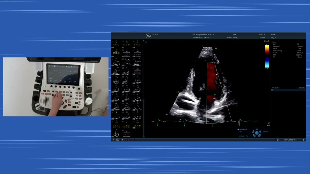 〖Echocardiography〗 Apical views hands-on - Color M-Mode, diastolic dysfunction & the RV (TAPSE, S')