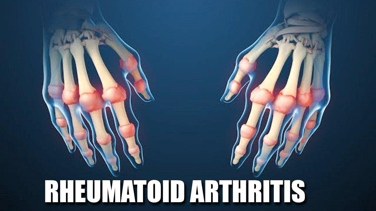 Rheumatoid Arthritis | Dr Vijaya Prasanna | Citi Neuro Centre - Hyderabad