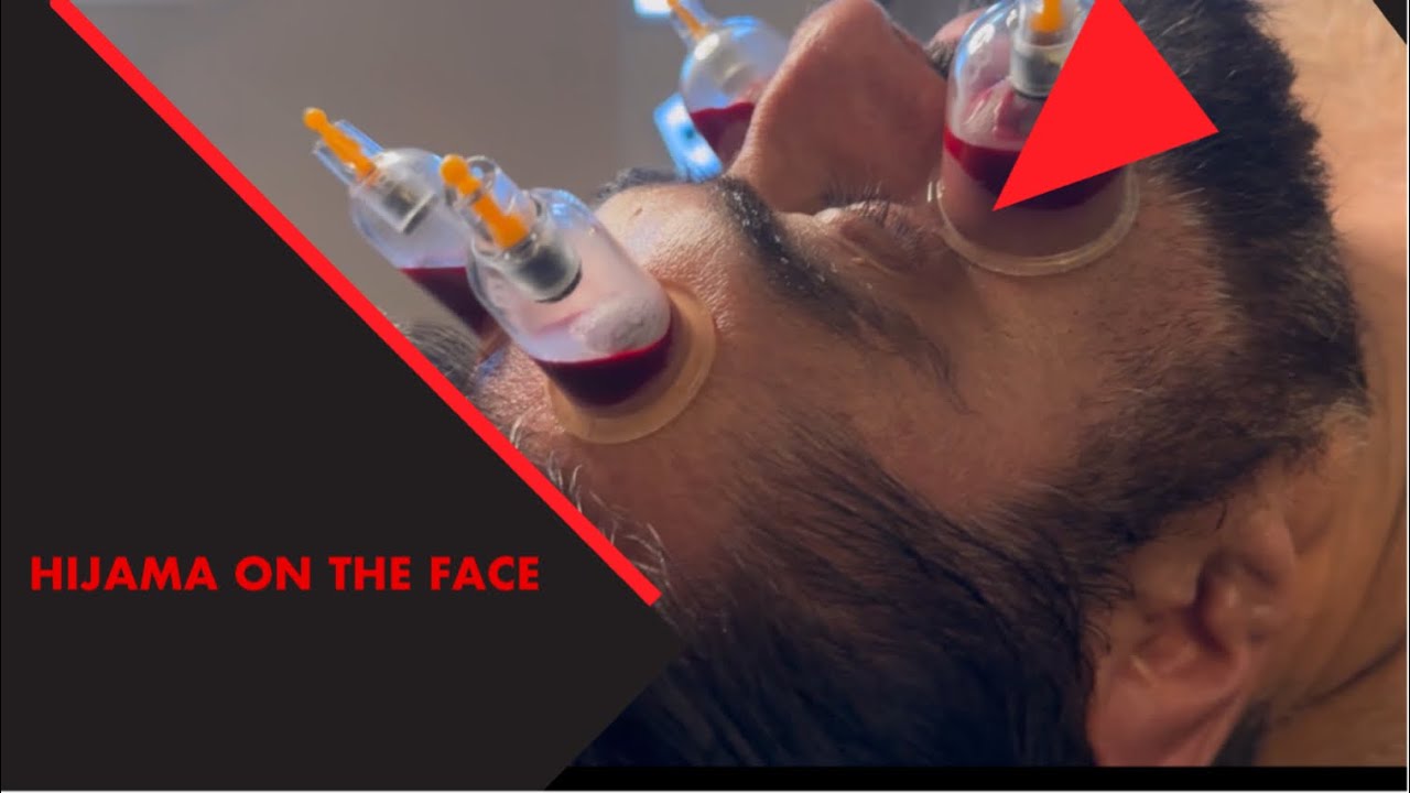 15 years of sinus congestion sorted with Hijama therapy !!