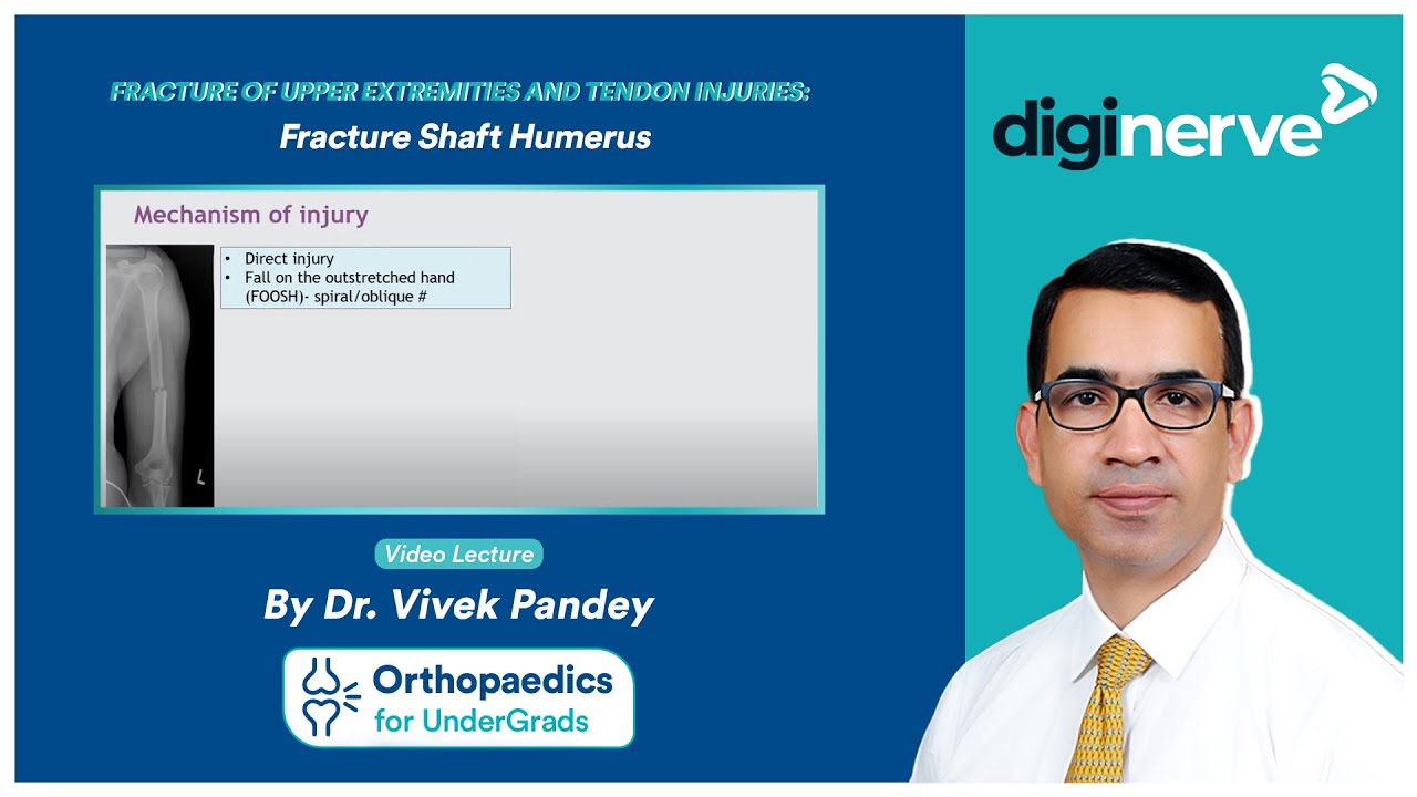 Fracture of Upper Extremities and Tendon Injuries: Fracture Shaft Humerus - Dr. Vivek Pandey