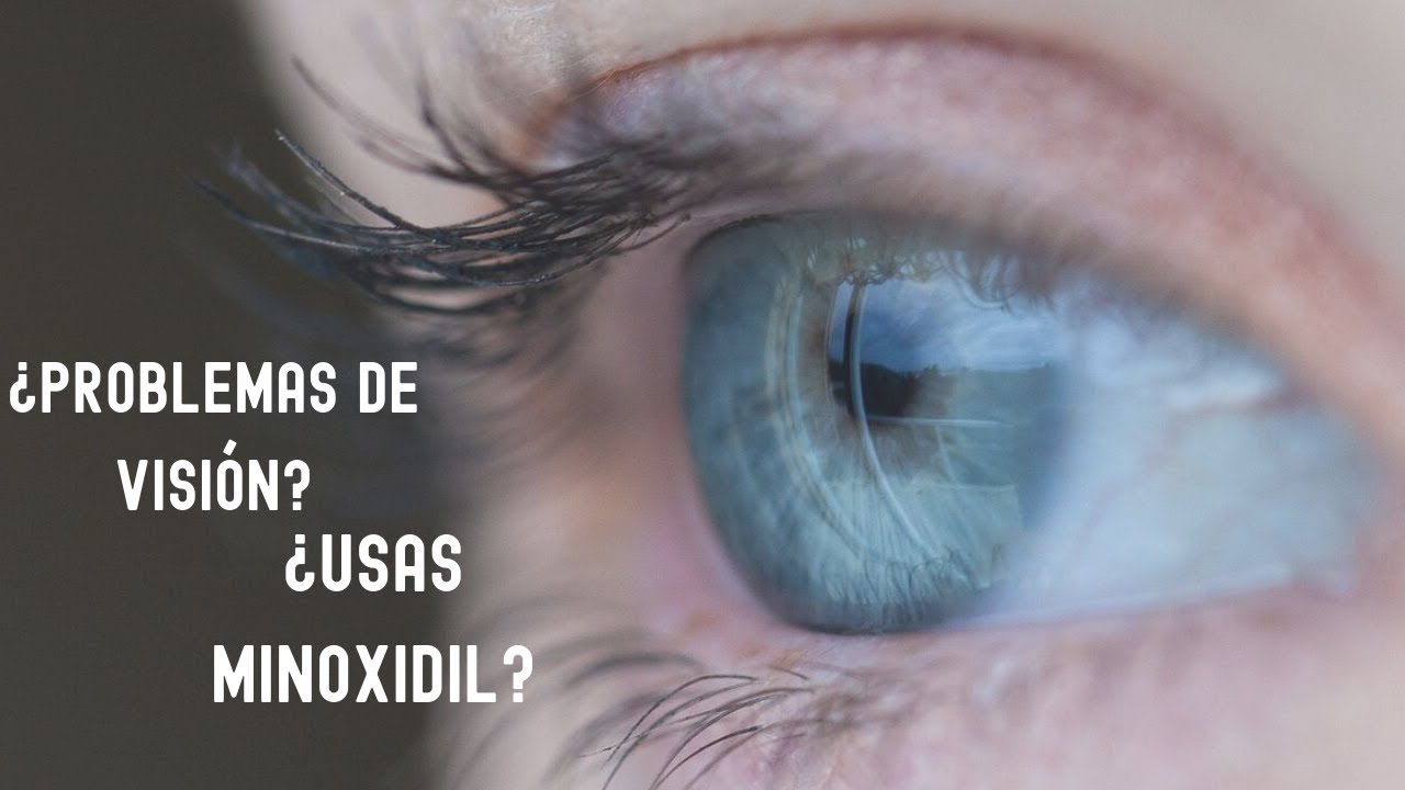 &iquest;USAS MINOXIDIL? &iexcl;&iexcl;ATENTO A TUS OJOS!!