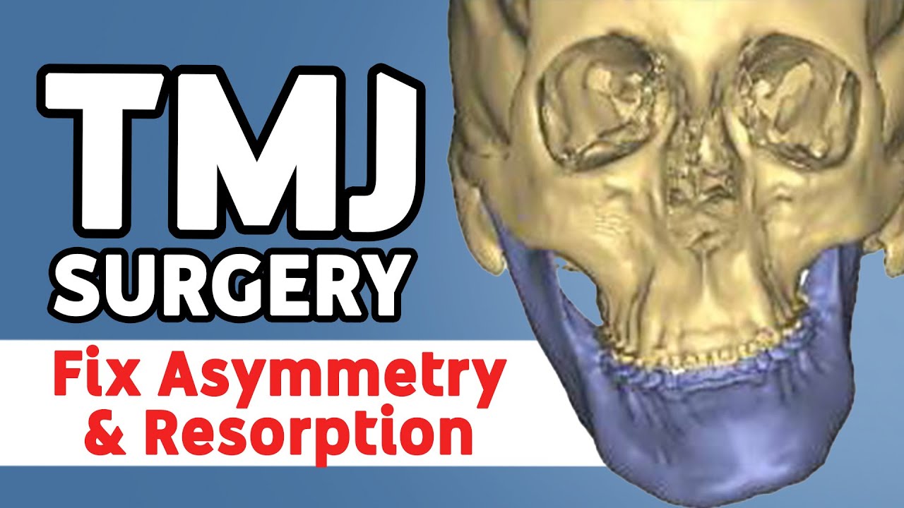 TMJ Surgery Explained: When It’s Done with Jaw Surgery
