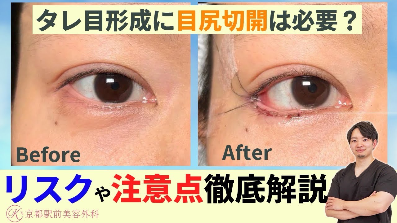 タレ目にしたいのに目尻切開って必要なの？
