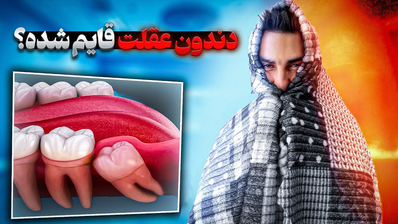 جراحی دندان عقل نهفته
